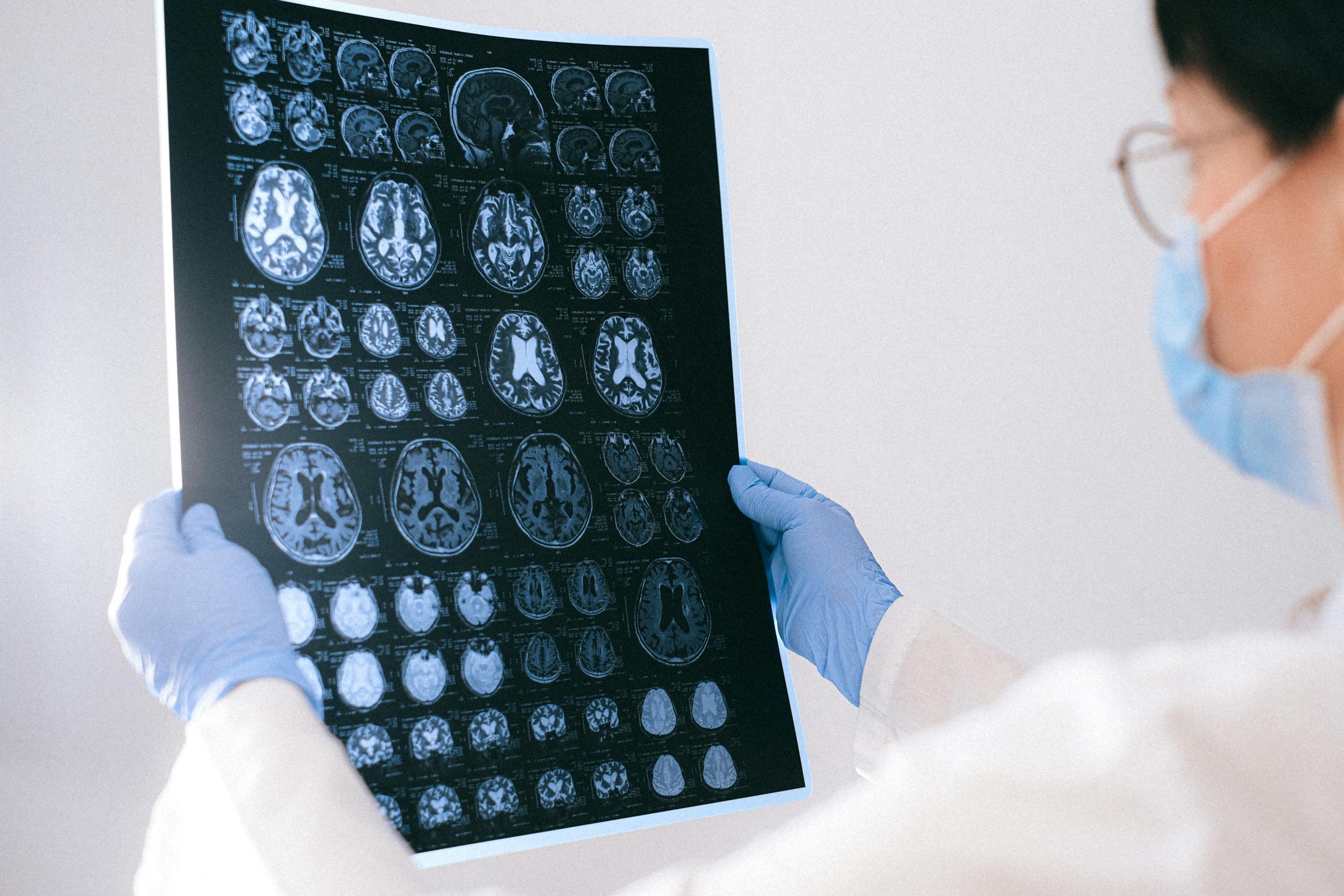 Doctor examining brain scans, representing stroke and neurological complications linked to Depo-Provera lawsuits.