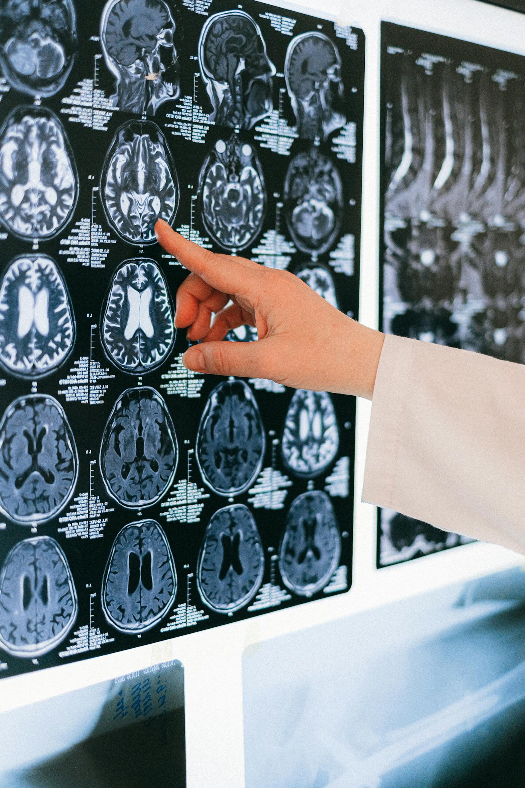 Doctor pointing at brain scans highlighting potential stroke complications linked to Depo-Provera.