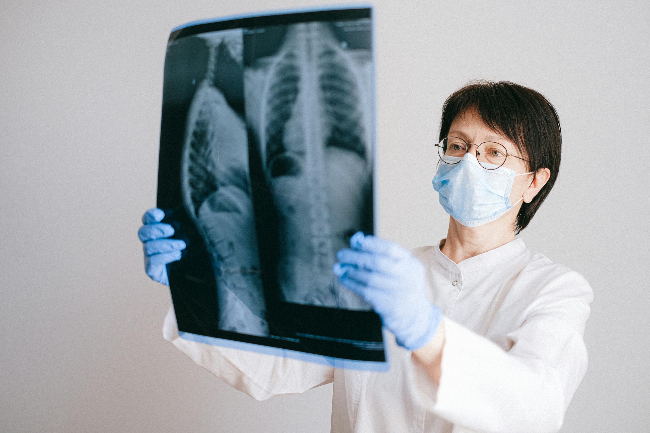 Doctor reviewing chest X-ray for signs of mesothelioma caused by asbestos exposure