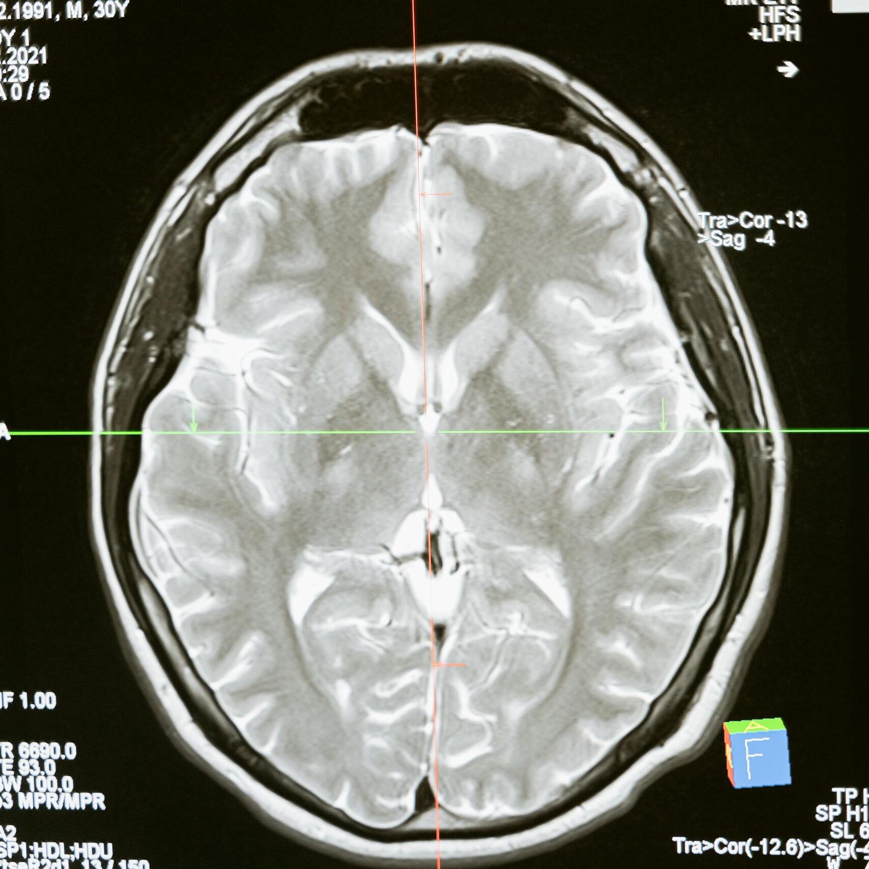 MRI scan showing meningioma brain tumor used as medical evidence in a depo provera lawsuit case