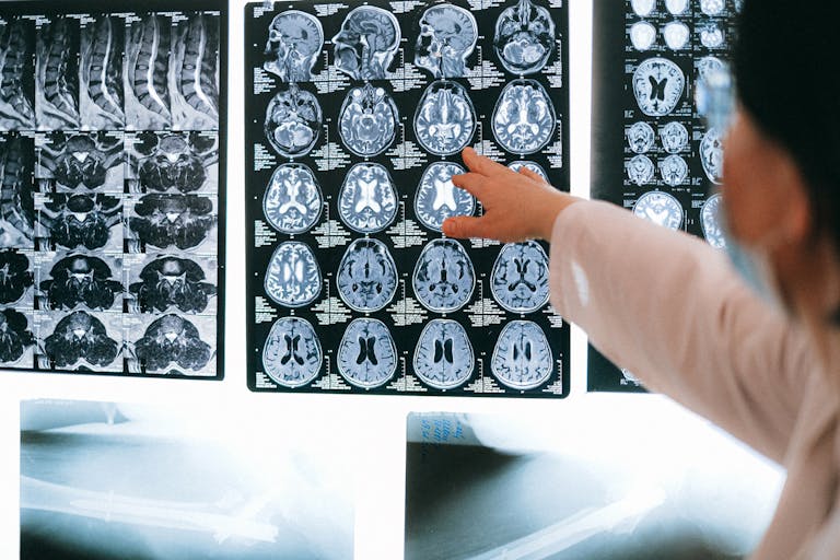Doctor reviewing brain MRI scans related to Depo-Provera meningioma lawsuit